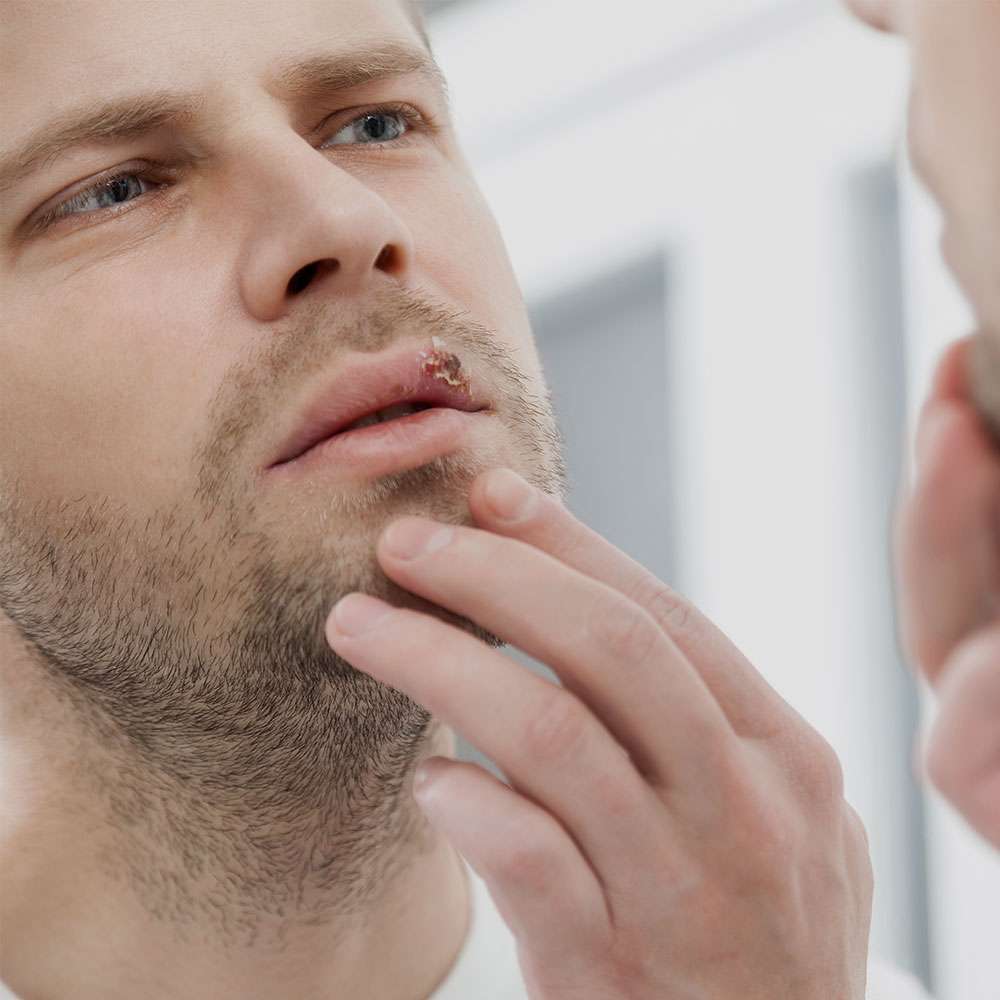 man with cold sore
